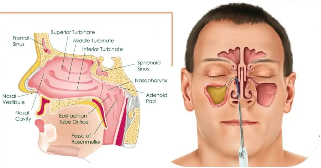 Natural Ways And Tips To Keep Yourself Sinus Infection Free