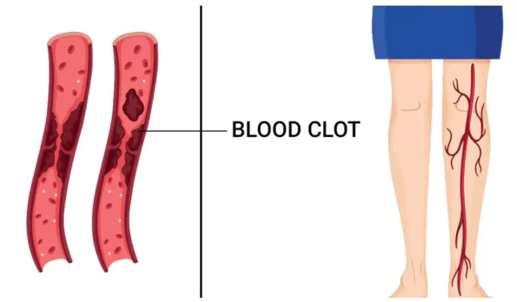 symptoms of blood clot