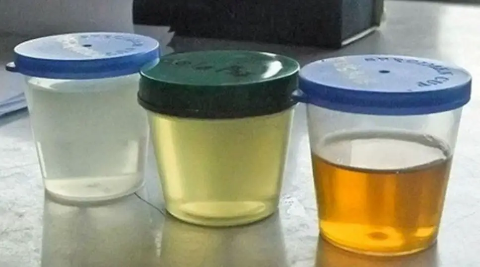 The Color Of Your Urine Can Reveal If You Suffer From Some Health Issues