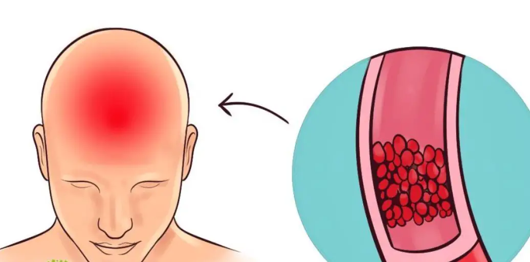 Could This Mineral and Vitamin Combo Be the Secret to Stopping Headaches