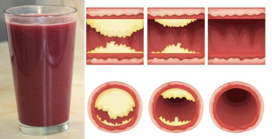 Beet Juice And Clogged Arteries