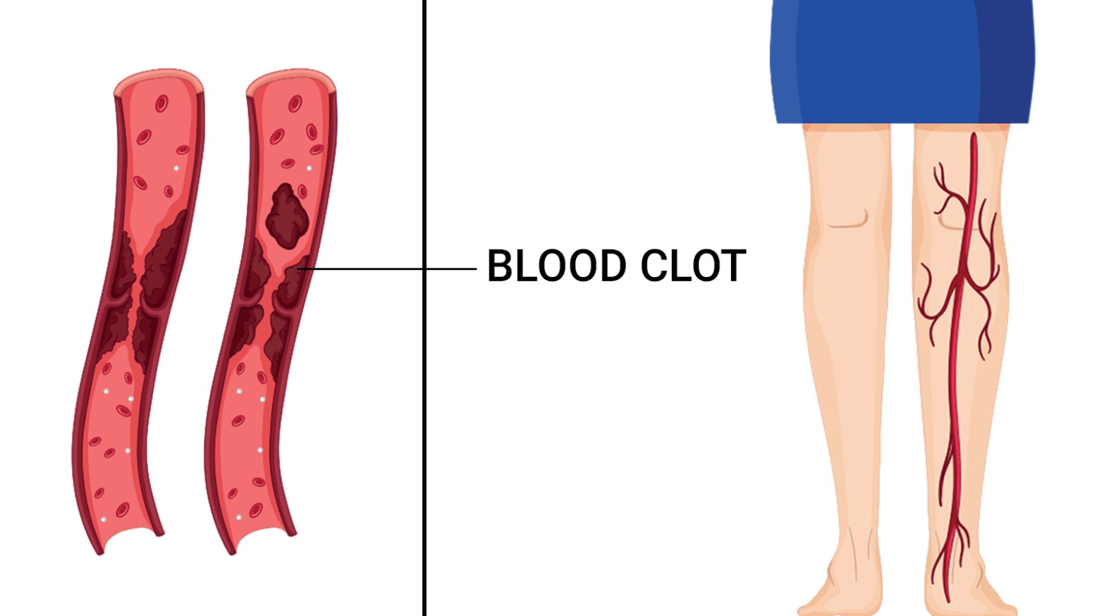 Do Not Ignore These Signs They Can Signal a Blood Clot!